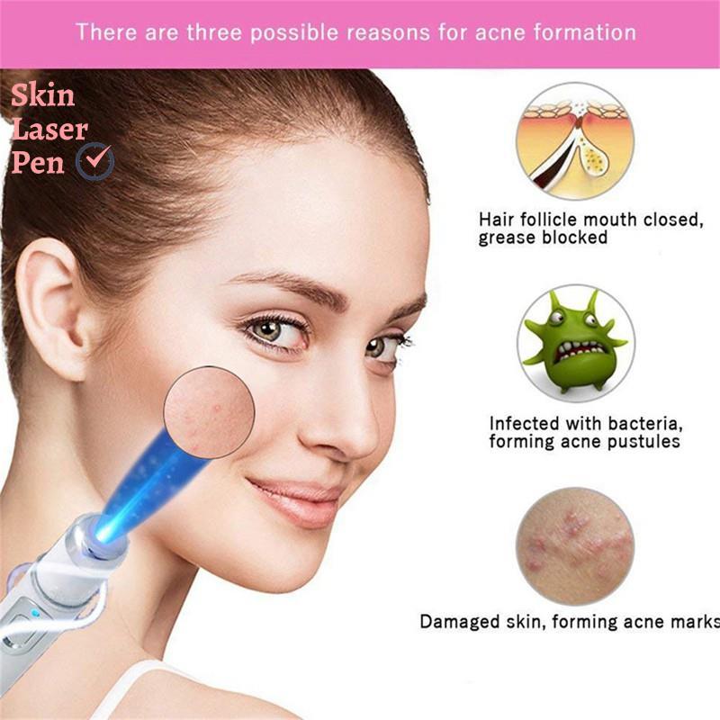 Acne Removal Device