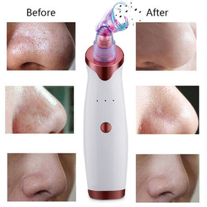 Super Suction Blackhead Remover